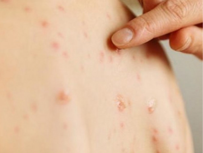 ХӨСҮТ: Улаанбурхан өвчний батлагдсан тохиолдол 3 нэмэгджээ